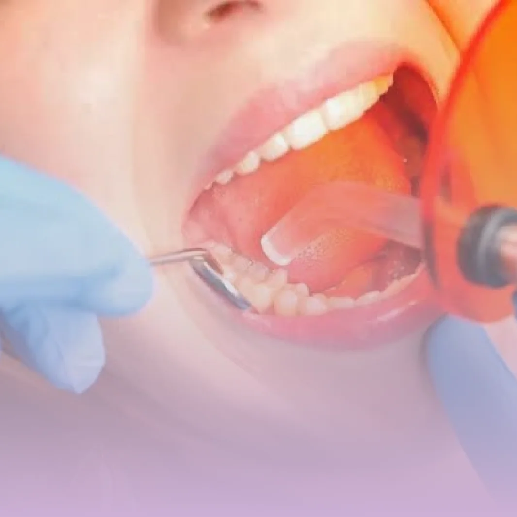 Restauração dentária na Contreras Odontologia, em Santa Felicidade, Curitiba