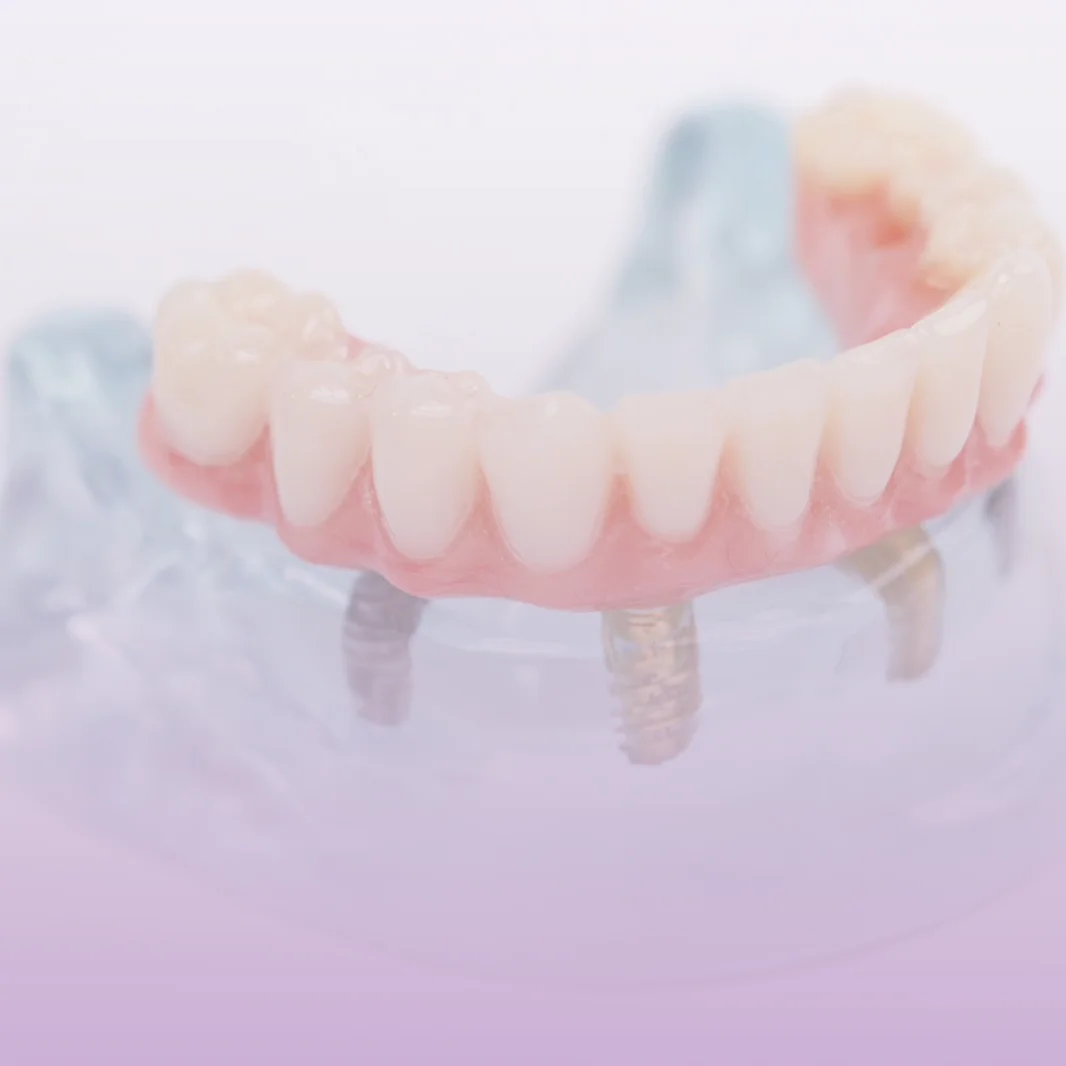 Prótese protocolo fixa sobre implantes na Contreras Odontologia, em Curitiba