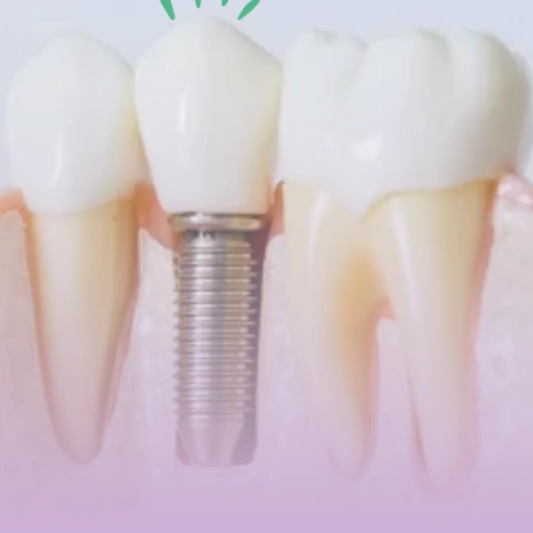 Implante dentário na Contreras Odontologia, em Santa Felicidade, Curitiba