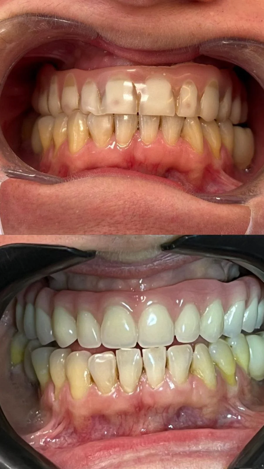 Antes e depois da troca de uma prótese antiga por prótese nova, caso atendido na Contreras Odontologia